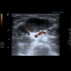 Myxofibrosarcoma of arm: US - Ultrasound
